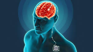 Estimulación Cerebral Profunda (ECP) como tratamiento de los trastornos mentales graves